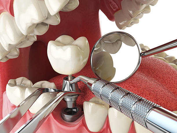 Best Urgent Tooth Repair  in Cressona, PA